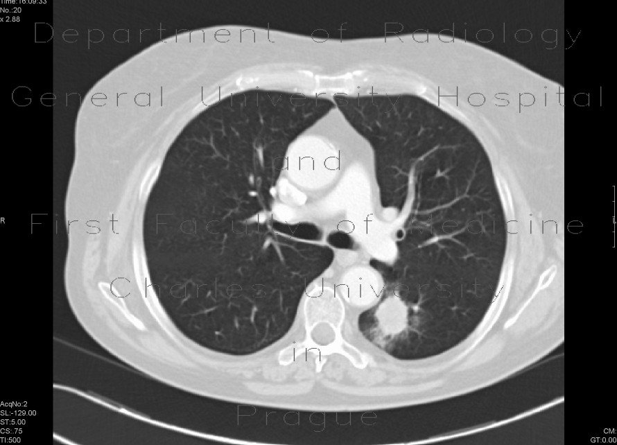Radiology image - Small cell carcinoma of the lung: Thorax, Lung: CT - Computed tomography