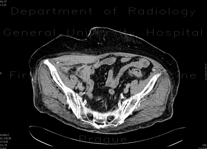 Radiology image - Small hematoma in the right groin, after angiography: Abdomen, Retroperitoneum, pelvis, Vessels: CT - Computed tomography