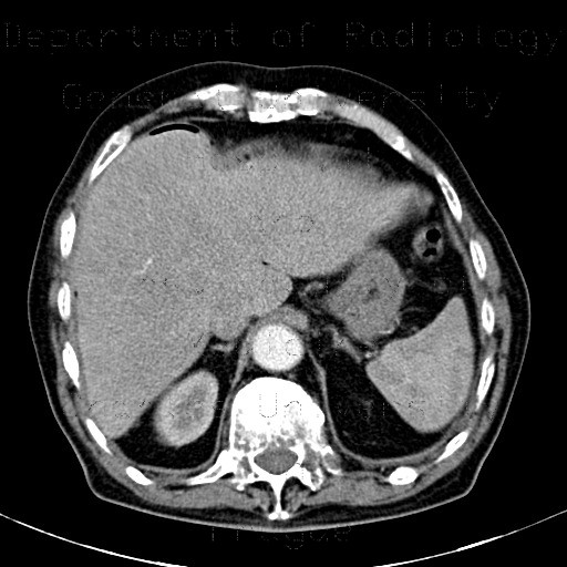 Radiology image - Small pneumoperitoneum, perforation of sigmoid colon, acute diverticulitis: Abdomen, Large bowel, Peritoneal cavity: CT - Computed tomography