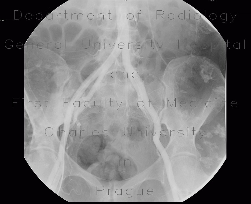 Radiology image - Soft tissue calcifications: Abdomen, Soft tissue: AG - Angiography