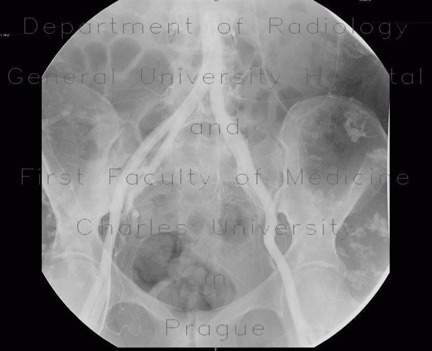 Soft tissue calcifications