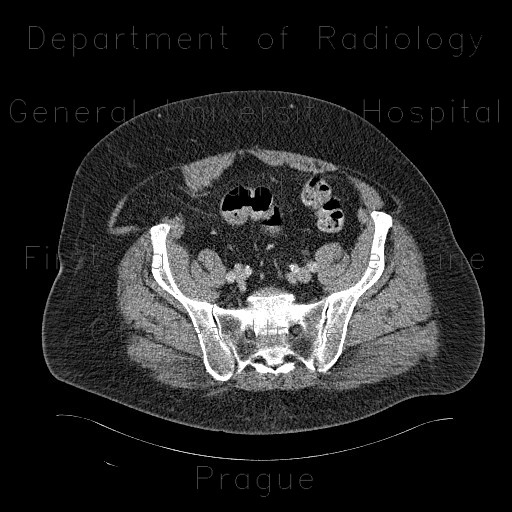 Spiegelian hernia