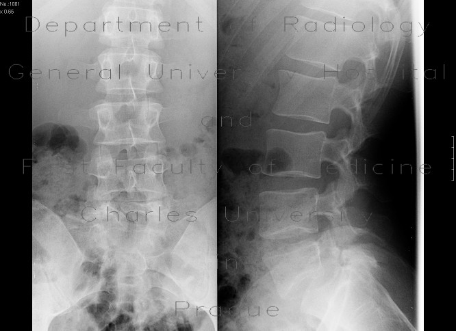 Radiology image - Spina bifida: Spine and Axial, Bone: X-ray - Plain radiograph