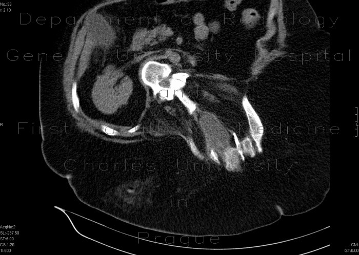 Radiology image - Spina bifida occulta, meningocoele, sacral: Spine and Axial, Bone, Brain: CT - Computed tomography