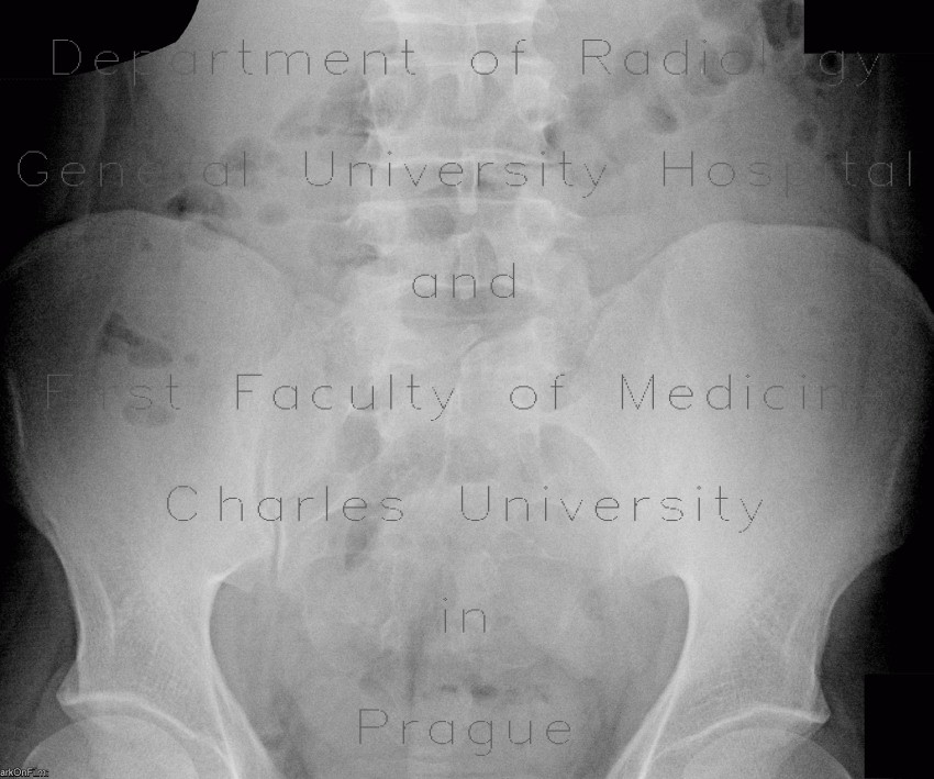Spina bifida, sacral vertebra