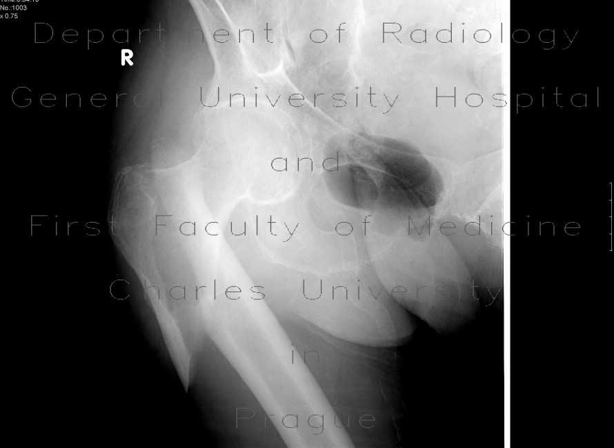 Spiral subtrochanteric fracture