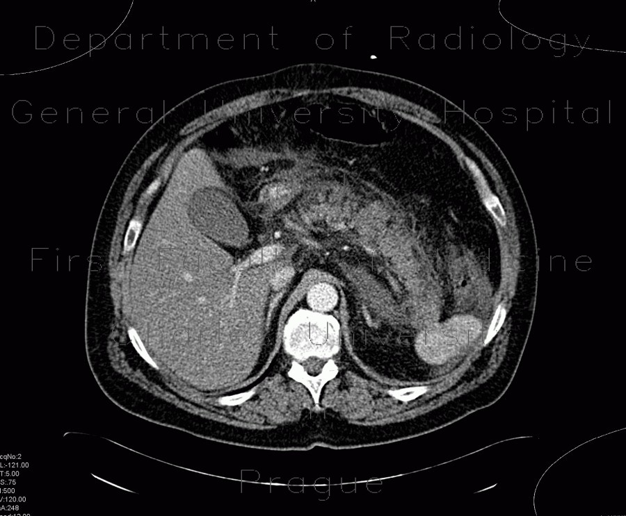 Splenectomy, regenerative splenunculus