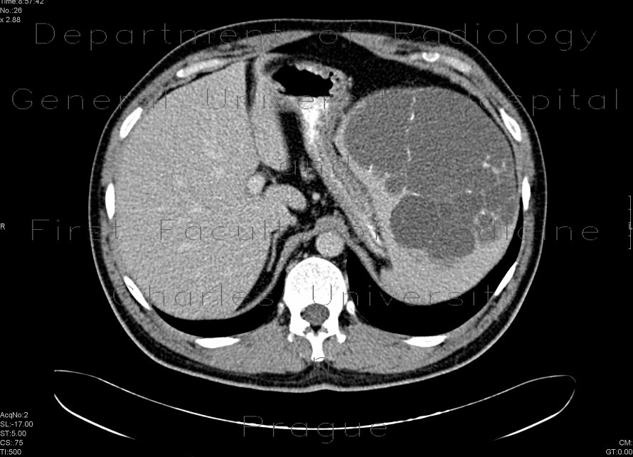 Splenic cysts, congenital, epithelial