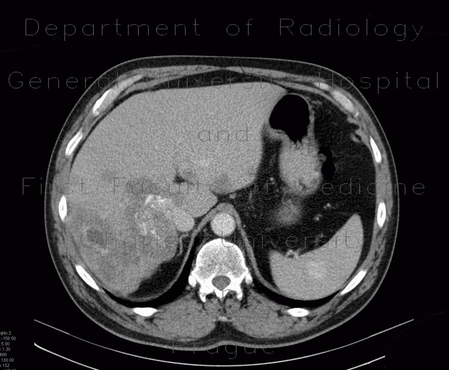 Radiology image - Splenic hemangioma, liver metastases, colon carcinoma: Abdomen, Liver, Lymphatic: CT - Computed tomography