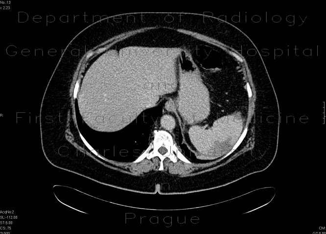 Radiology image - Splenic infarction: Abdomen, Lymphatic: CT - Computed tomography