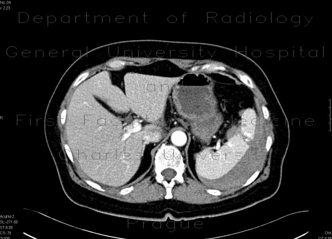 Radiology image - Splenic rupture: Abdomen, Lymphatic: CT - Computed tomography