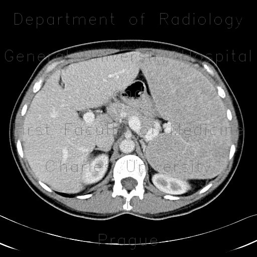 Splenomegally, lymphoma