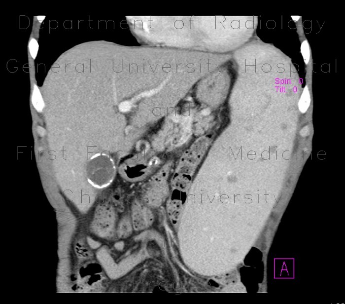 Radiology image - Splenomegally, porcelain gall bladder: Abdomen, Biliary tree, Lymphatic: CT - Computed tomography