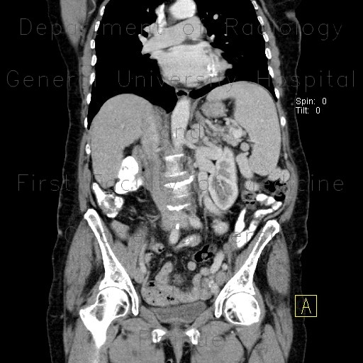 Radiology image - Splenorenal collaterals, shunting: Abdomen, Vessels: CT - Computed tomography