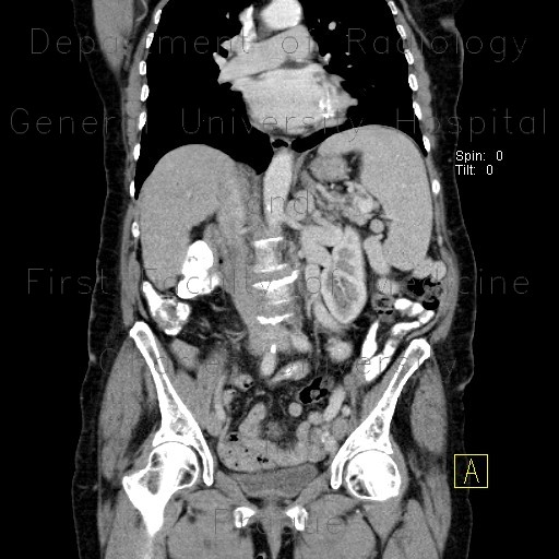 Splenorenal collaterals, shunting