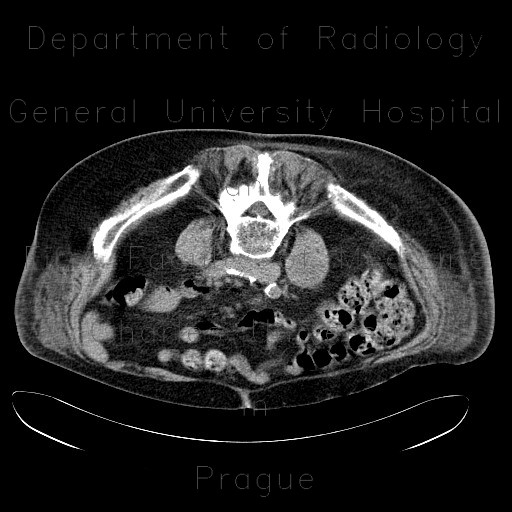 Spondylodiscitis, abscess of psoas muscle, drainage of abscess