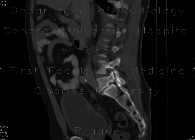 Radiology image - Spondylolisthesis, isthmic spondylolysis: Spine and Axial, Bone: CT - Computed tomography