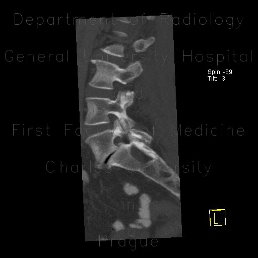 Radiology image - Spondylolisthesis, spondylolysis, lumbar vertebra: Spine and Axial, Bone: CT - Computed tomography