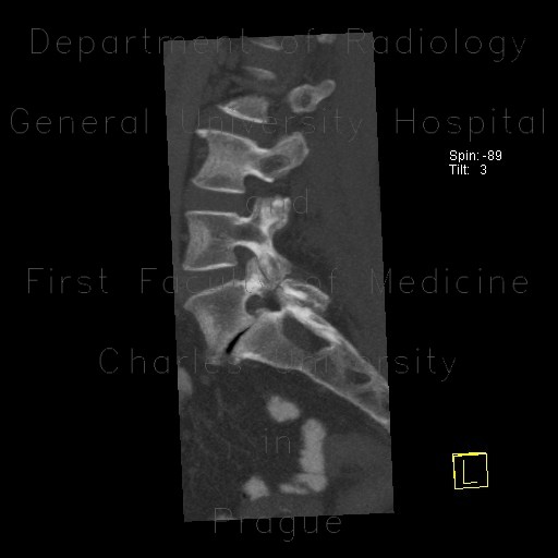 Spondylolisthesis, spondylolysis, lumbar vertebra