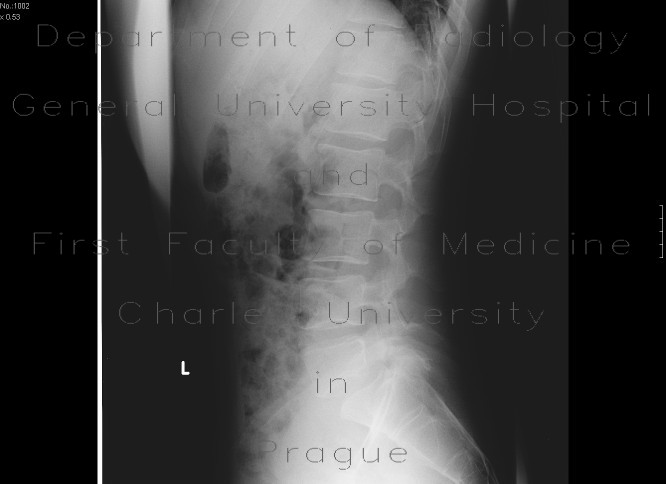 Radiology image - Spondylolisthesis, spondylolysis, spina bifida: Spine and Axial, Bone: X-ray - Plain radiograph