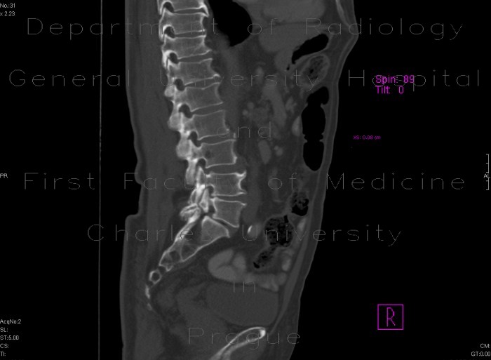 Radiology image - Spondylolysis, spondylolisthesis, lumbar vertebra: Spine and Axial, Bone: CT - Computed tomography