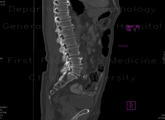 Spondylolysis, spondylolisthesis, lumbar vertebra