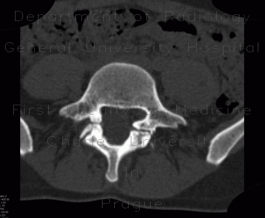 Radiology image - Spondylolysis, spondylolisthesis, olisthesis: Spine and Axial, Bone: CT - Computed tomography