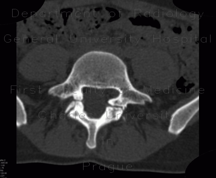 Spondylolysis, spondylolisthesis, olisthesis