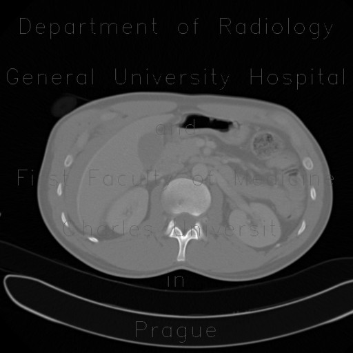 Radiology image - Stab wound of liver with active bleeding, hemorrhage: Abdomen, Liver: CT - Computed tomography