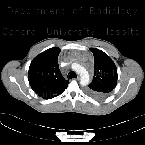 Stab wound of the thorax, perforation of the ascending aorta, bleeding into mediastinum, hemothorax