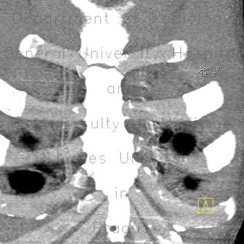 Radiology image - Stab wound of thorax, internal mammary artery and aortic arch, mediastinal hemorrhage, hemothorax: Thorax, Lung, Mediastinum and pleural cavity, Vessels: CT - Computed tomography