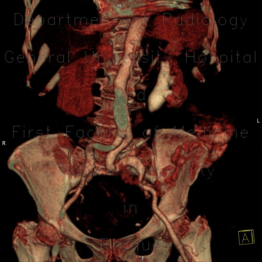 Radiology image - Staghorn calculus, casting stone, nephrolithiasis, VRT: Abdomen, Kidney and adrenals, Urinary tract: CT - Computed tomography