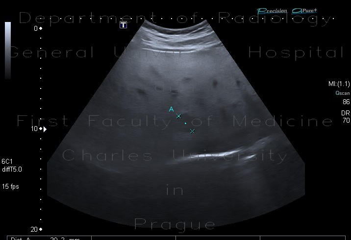 Radiology image - Steatosis, fatty liver, focal sparing: Abdomen, Liver: US - Ultrasound
