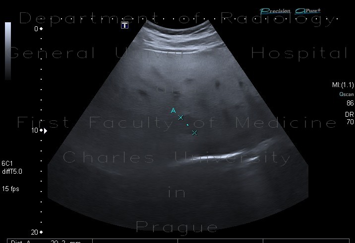 Steatosis, fatty liver, focal sparing