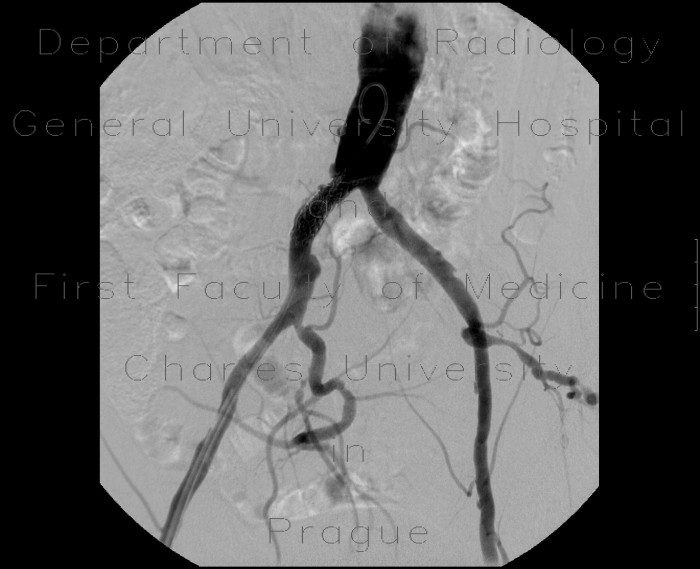 Stenosis of common iliac artery, stent