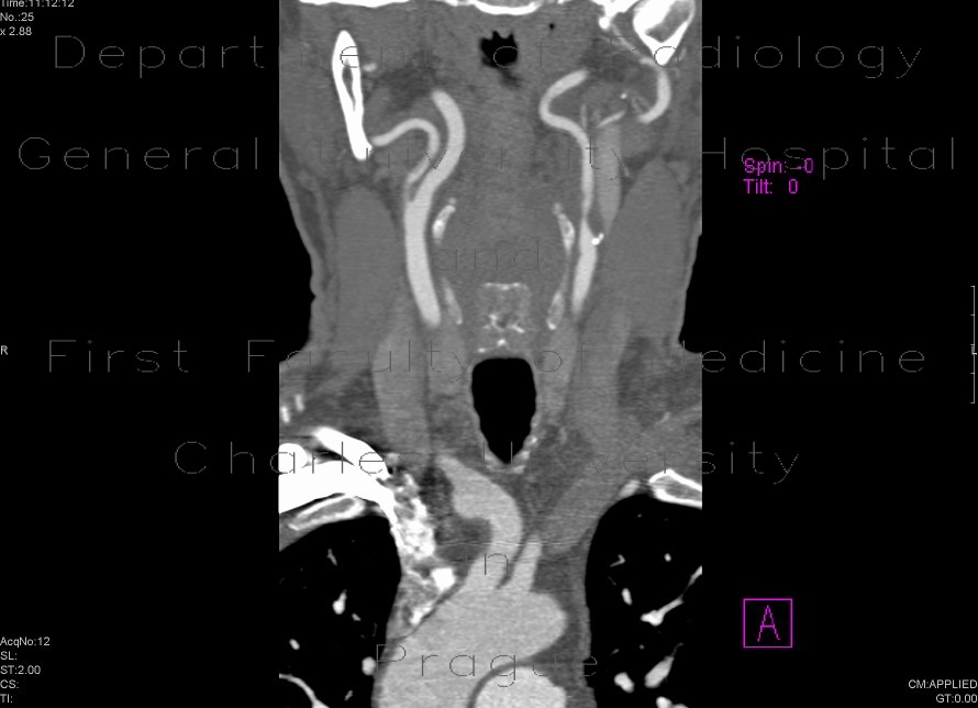 Stenosis of internal carotid artery