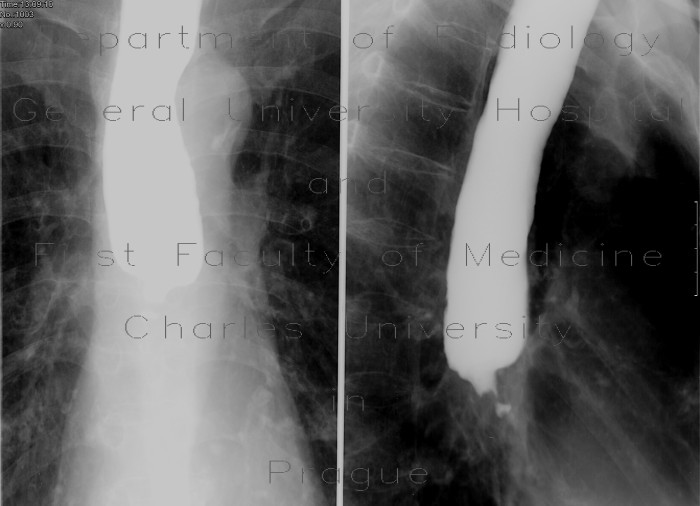 Stenosis of oesophagus