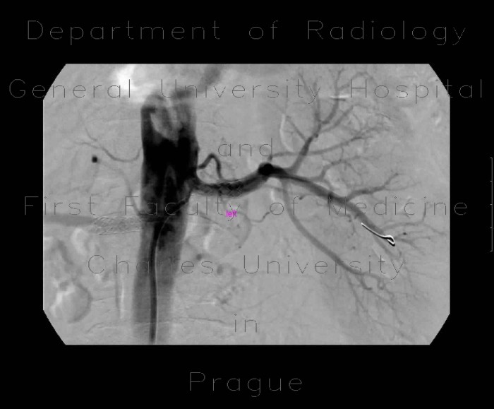 Stenosis of renal artery, stent