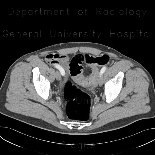 Radiology image - Stenosis of sigmoid colon and lienal flexure, inflammatory stenosis, CT colonography: Abdomen, Large bowel: CT - Computed tomography