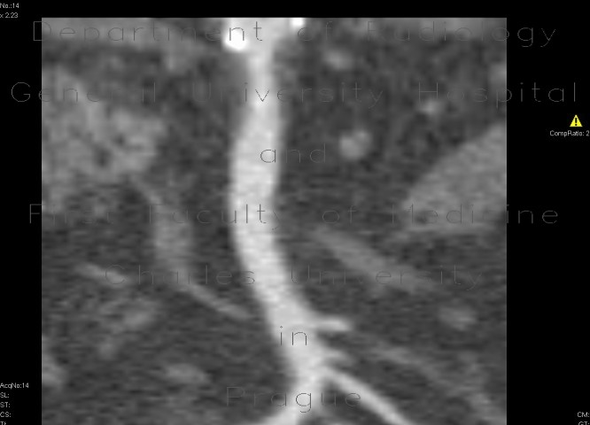 Radiology image - Stenosis of the superior mesenteric artery, AMS: Abdomen, Vessels: CT - Computed tomography
