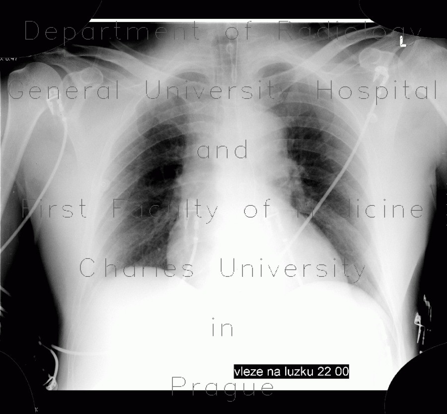 Stenosis of trachea, tracheal intubation