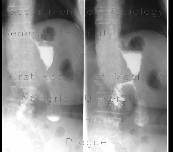 Radiology image - Stomach resection, Billroth II: Abdomen, Small bowel, Stomach: RF - Fluoroscopy