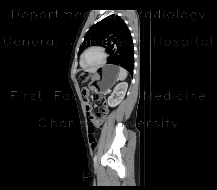 Radiology image - Stomach tumour: Abdomen, Large bowel, Stomach: CT - Computed tomography