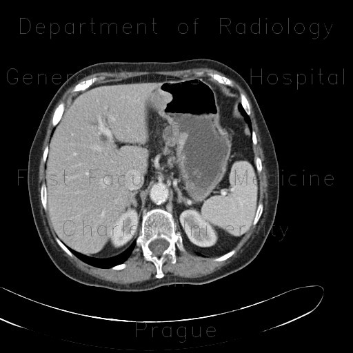 Radiology image - Stomach tumour, enlarged regional lymph nodes: Abdomen, Stomach: CT - Computed tomography
