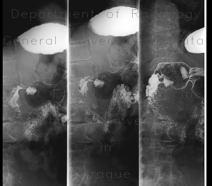 Stomach ulcer