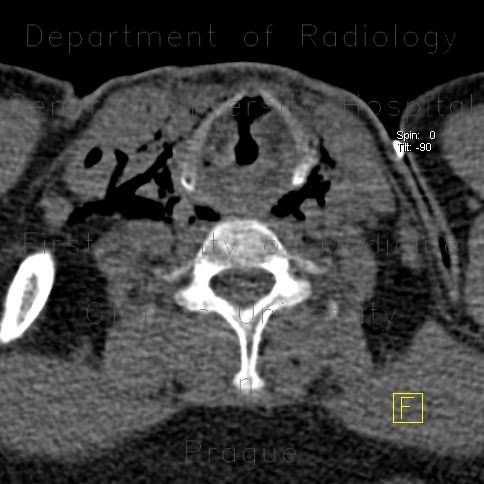 Radiology image - Strangulation, suicidal attempt, emphysema of neck: Head and Neck, Soft tissue: CT - Computed tomography