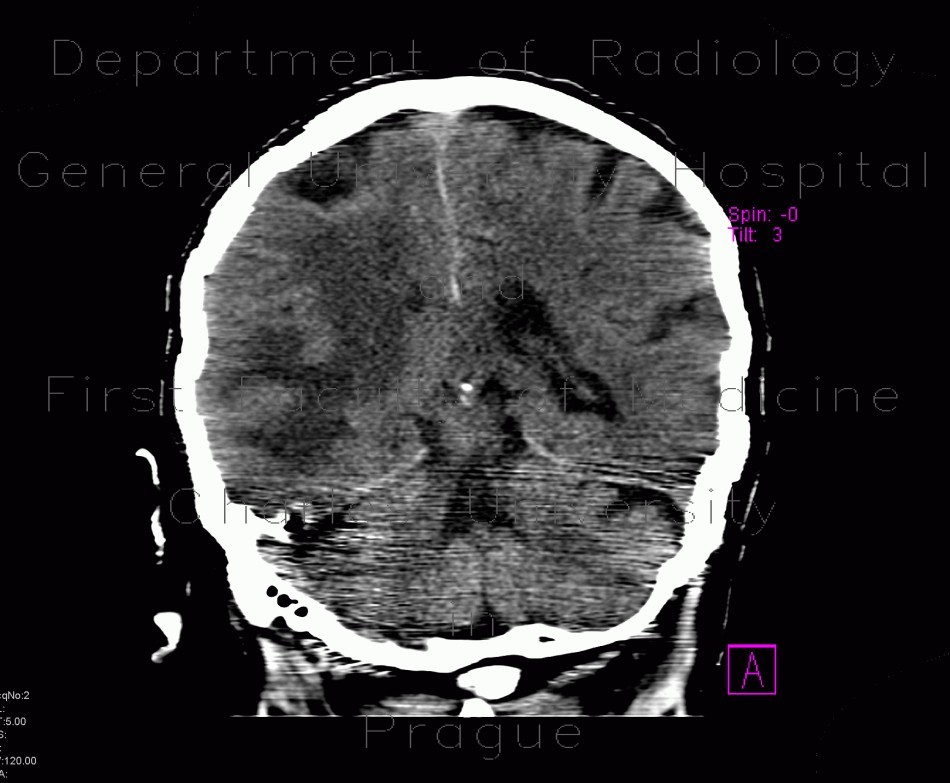 Stroke, brain ischemia, fresh