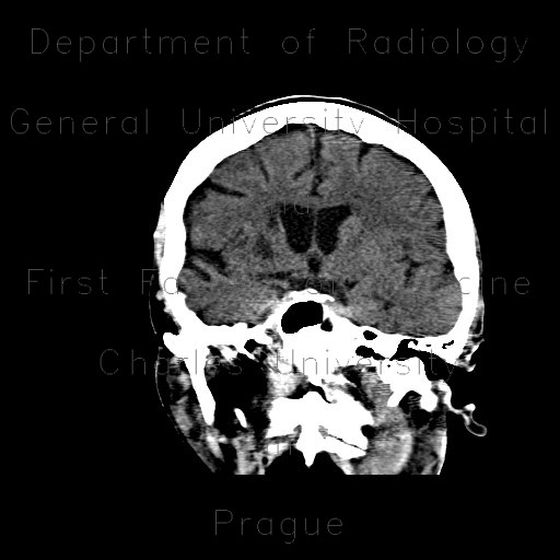 Radiology image - Stroke, cerebral ischemia, insula, caudate: Brain, Brain: CT - Computed tomography