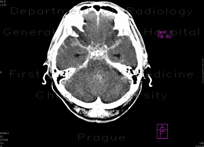 Radiology image - Subarachnoid hemorrhage: Brain, Brain: CT - Computed tomography