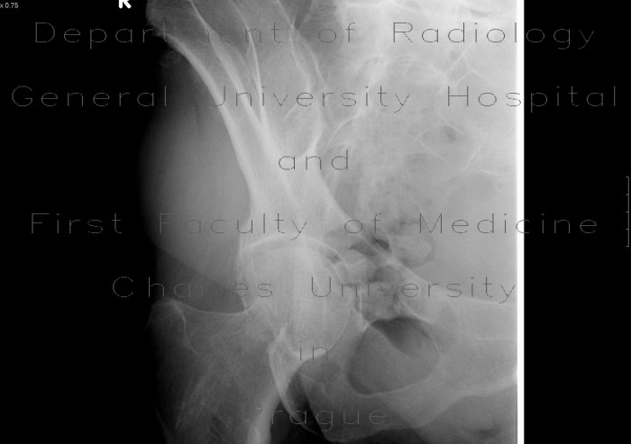 Subcapital fracture of femur